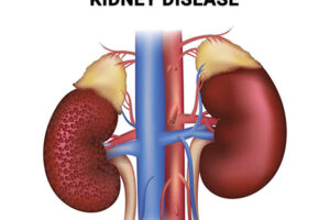 Six Major Causes of Kidney Disease